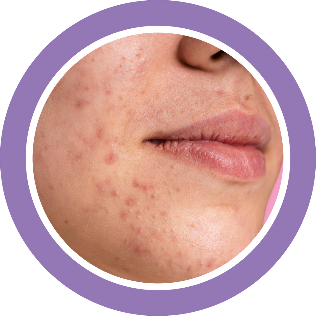 How to Get Rid of Zits Overnight 🤨💤