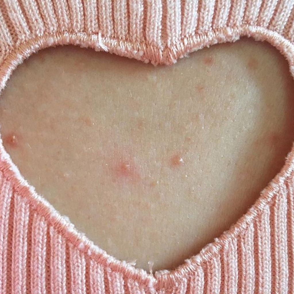 How To Do A Skin Care Patch Test 💖