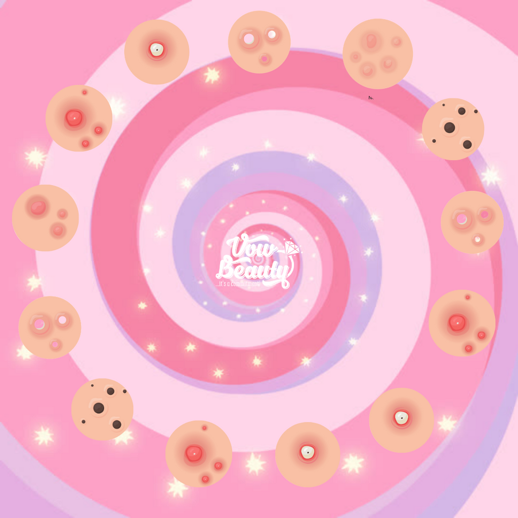 Can Skincare Cause Acne? 🤓